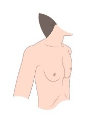 Pectus convex chest wall disorder