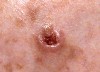 Photo of an example of Basal Cell Carcinoma (BCC)