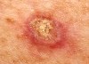 Photo of an example of Squamous Cell Carcinoma (SCC)