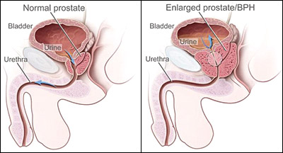 Illustration demonstrating the size difference between a normal prostate and an enlarged prostate / BPH