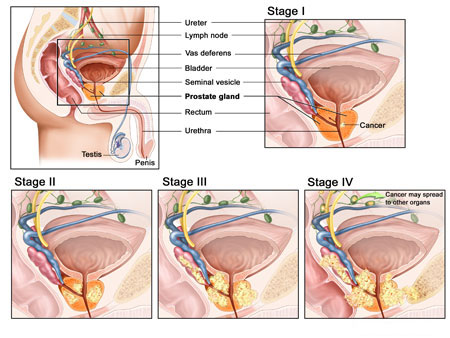 Medical illustration of the male sexual and renal systems illustrating the difference in prostate size and cancer progression at normal, stage 1, stage 2, stage 3, and stage 4 of prostate cancer, noting at stage 4 cancer may spread to other organs