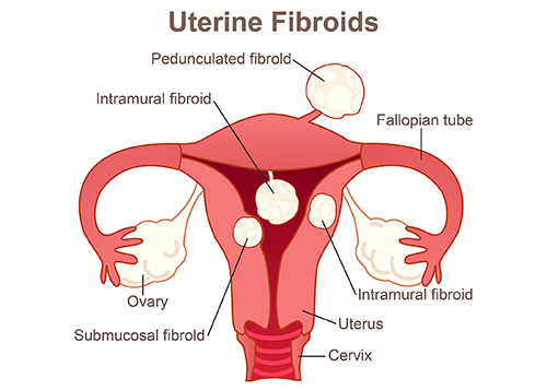A medical illustration of the female reproductive system labeled Uterine Fibroids, showing the various locations where fibroids can develop, including pedunculated, intramural, and submucosal types within the uterus